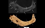 El caso de cáncer más antiguo en el hombre tiene 3.200 años
