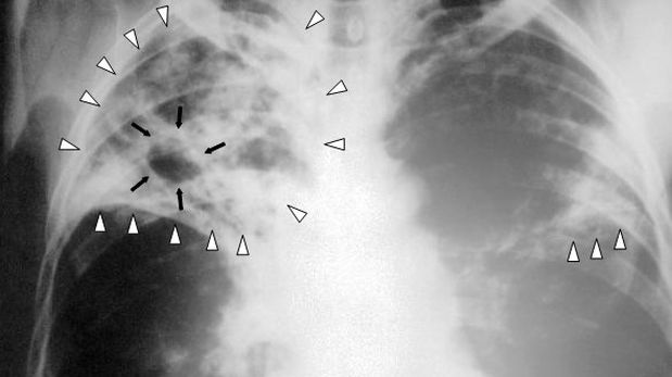 La tuberculosis se puede transmitir de manera congénita