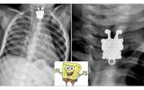 Facebook: niña se tragó collar de Bob Esponja de su hermana