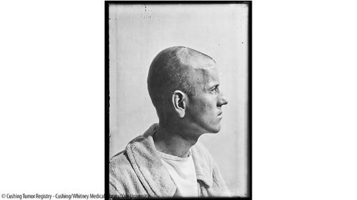 Cushing tomaba fotografías de sus pacientes, en tiempos que no se hacían ese tipo de prácticas, para mejorar los procedimientos médicos. (Foto: Cushing Medical Library)