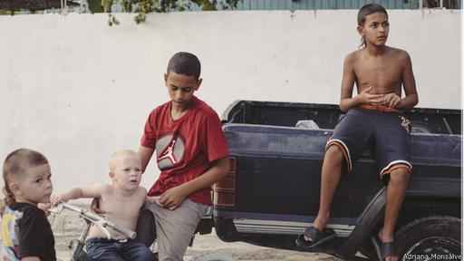 Según cifras oficiales, al año nacen 56 niños con algún tipo de albinismo. (Foto: Adriana Monsalve)