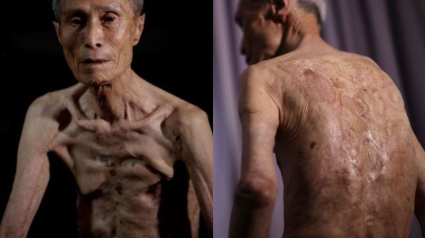 Sumiteru Taniguchi el mes pasado recordó la historia de cómo había pasado tres días vagando en un sueño, sin ser consciente de la gravedad de sus heridas. (Foto: AFP)