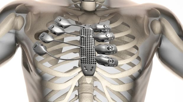 Un paciente español de 54 años que perdió su esternón debido al cáncer recibió una prótesis impresa en titanio. (Foto: Anatomics)