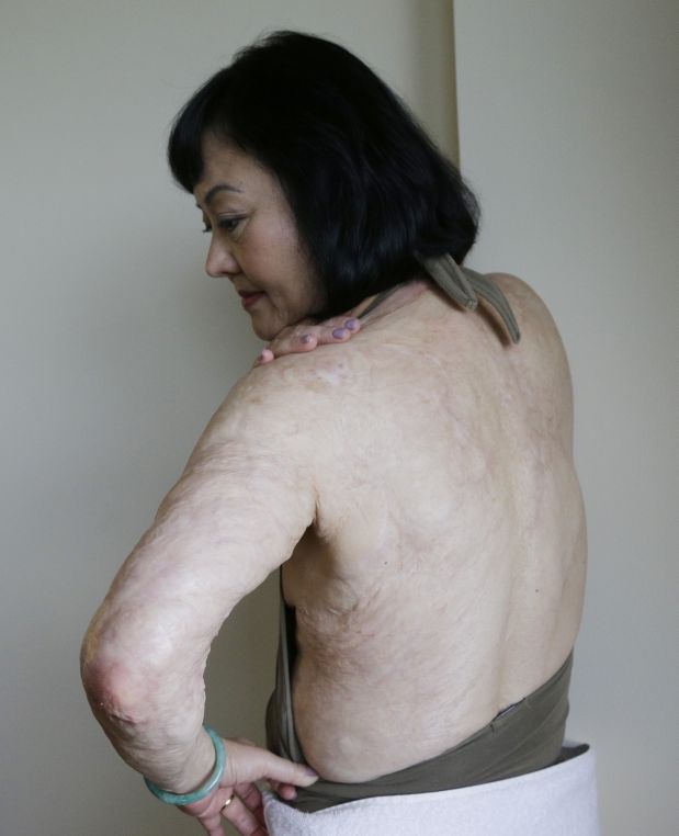 In this Sept. 25, 2015 photo, Kim Phuc shows burn scars on her back and left arm at a hotel in Miami. The scars were caused by a napalm attack when she was 9 years old in Trang Bang, Vietnam. While she spent years doing painful exercises to preserve her range of motion, her left arm still doesn't extend as far as her right arm, and her desire to learn how to play the piano has been thwarted by stiffness in her left hand. Tasks as simple as carrying her purse on her left side are too difficult. (AP Photo/Nick Ut)