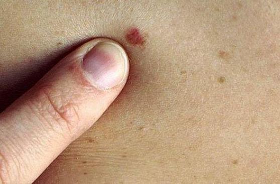 ¿Cómo identificar lunares posiblemente cancerosos?