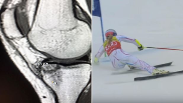 Resonancia de la esquiadora Lindsey Vonn descarta grave lesión