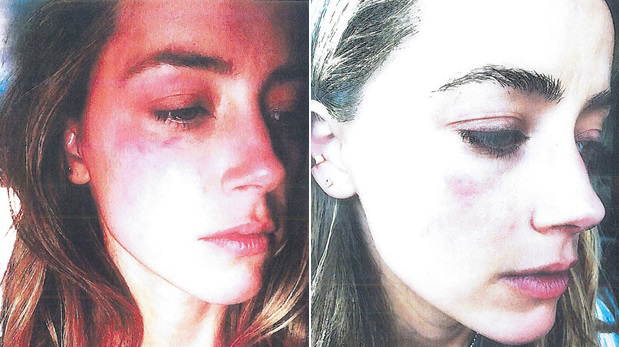 Fotografías de la primera agresión denunciada por Amber Heard. (Fotos: AP)