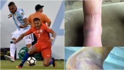 Alexis Sánchez publicó impactante foto de su tobillo maltrecho
