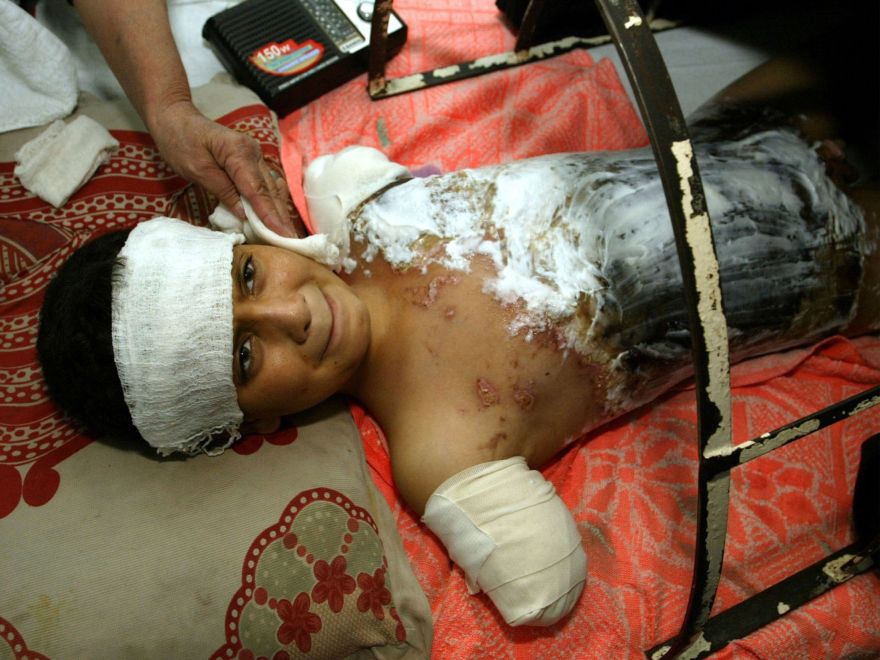 PICTURES OF THE YEAR 2003 - Ali Ismail Abbas, 12, wounded during an air strike according to hospital sources, lies in a hospital bed in Baghdad, April 6, 2003.   Abbas was fast asleep when war shattered his life. A missile obliterated his home and most of his family, leaving him orphaned, badly burned and without his arms.      REUTERS/Faleh KheiberOPSE_2003DIC09_RESUMEN_FIN DE A?O 2003_VICTIMAS DE LA GUERRA_NINO_MUTILADO_BRAZOS_ALI ISMAIL ABBAS_IRAQ_CONFLICTO_ESTADOS UNIDOS2003DIC09_AFD