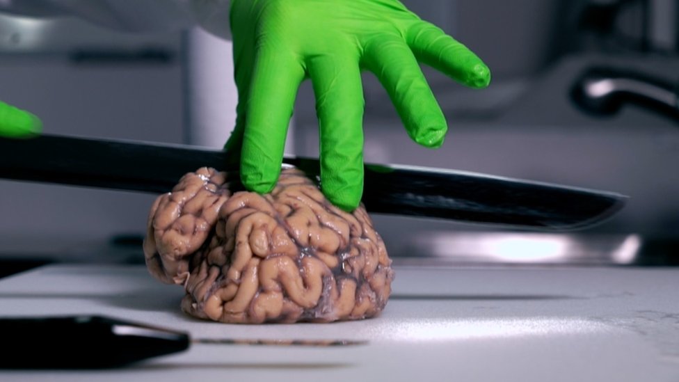 El tejido cerebral es un recurso vital de investigación. (Foto: BBC)