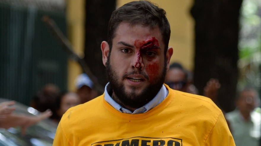 Venezuela. Juan Requesens quedó desfigurado durante una protesta. (AFP)