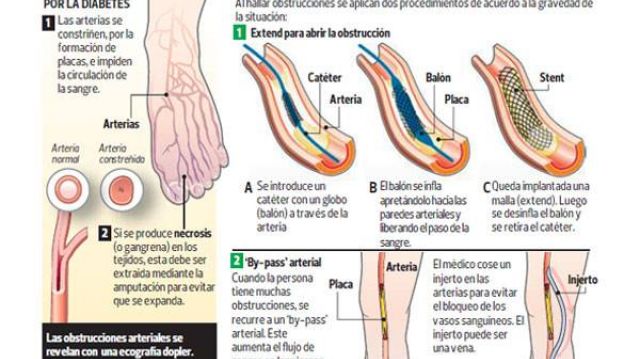 amputacion de miembros inferiores por diabetes