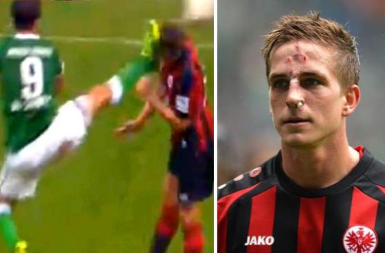 VIDEO: así quedó jugador del Frankfurt tras salvaje patada en la cara