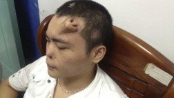 China: médicos desarrollan una nueva nariz en la frente de un paciente