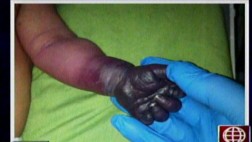 Bebe a punto de perder una mano por presunta negligencia médica