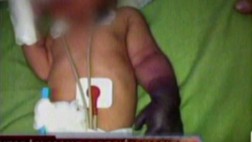 Confirman que recién nacida perderá su mano por negligencia