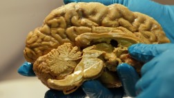 Descubren cómo se propagan las células cancerígenas al cerebro