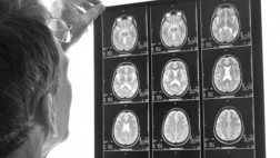 Factores que aumentan el riesgo de sufrir un derrame cerebral