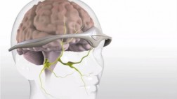 Sepa qué aparato lo ayudará a reducir y prevenir migrañas