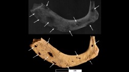 El caso de cáncer más antiguo en el hombre tiene 3.200 años