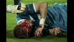 Lewandowski provocó esta terrible lesión en defensor del Zenit