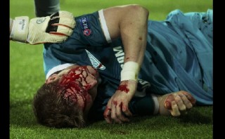 Lewandowski provocó esta terrible lesión en defensor del Zenit