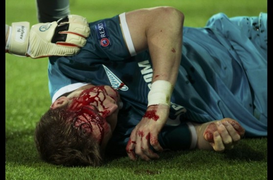Hubocan del Zenit y las dramáticas imágenes de su lesión