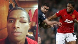 Valencia del Manchester United hizo un 'selfie' de su hematoma