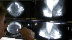 Encuentran relación entre cánceres de mama y útero