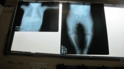 Bebe de 7 meses tiene 7 agujas incrustadas en su cuerpo