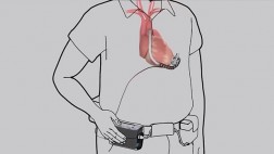 Implantan corazón mecánico como alternativa al trasplante
