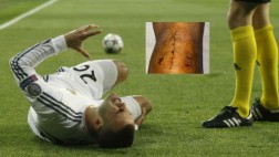 Jesé sigue de malas y ahora sufrió una infección en la rodilla