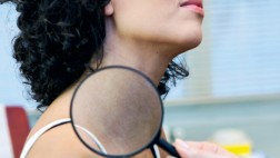 Vitiligo: Entérate más sobre este trastorno dermatológico
