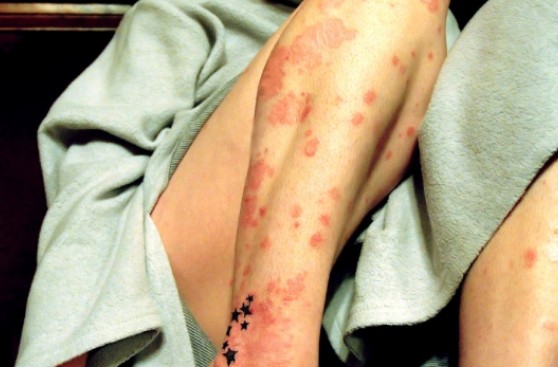 El apoyo psicológico es fundamental en pacientes con psoriasis