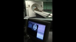 Tumores cerebrales ya se operan sin bisturí en Latinoamérica