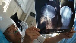 Hombre sobrevive a caída de cuchillo sobre su cabeza