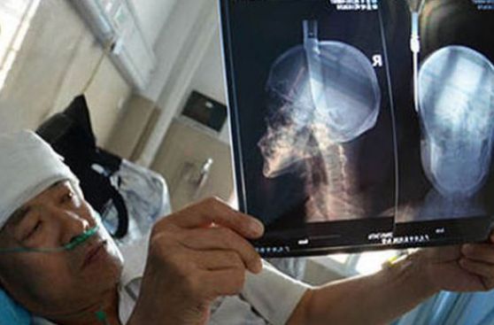 Hombre sobrevive a caída de cuchillo sobre su cabeza