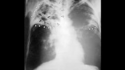 ¿Por qué hay una tuberculosis resistente a los antibióticos?