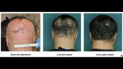 Medicamento revierte un tipo de alopecia en cuatro meses