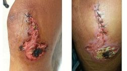 Ciclista está a punto de campeonar pese a tener así la rodilla