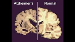 Consumir vitamina D te protegería contra la demencia