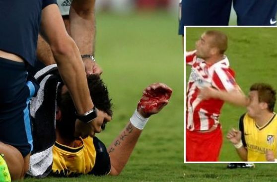 Mandzukic sufrió una fractura en la nariz y será operado mañana