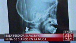 Callao: niña víctima de otra bala perdida espera ser operada