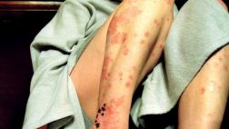 Terapia logra blanquear la piel de pacientes con psoriasis