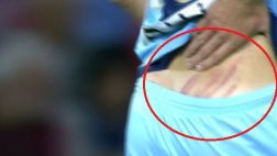 España: así quedó la espalda de jugador tras fortuito planchazo