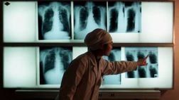 Aumentan los casos de tuberculosis resistente a fármacos