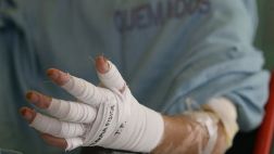 Cuatro niñas quemadas fueron trasladadas de Chiclayo a Lima