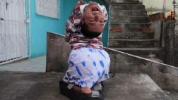 La valiente vida del brasileño que nació con la cabeza al revés