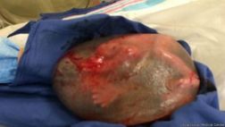 El extraño caso del bebe que nació dentro del saco amniótico