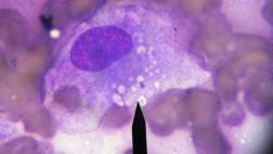 Hallan mecanismo celular que propicia la metástasis del cáncer